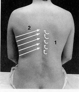 Tachycardia a ernia di reparto cervicale di una spina dorsale