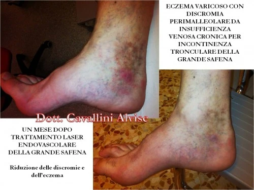 Zinco allatto di risposte di psoriasi