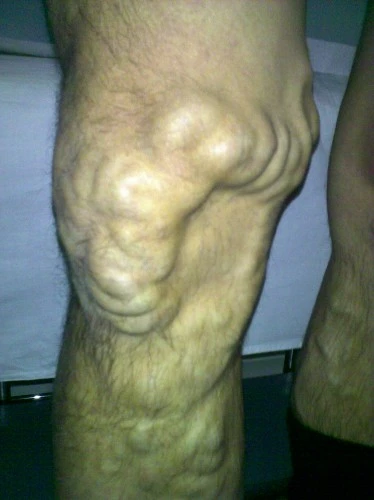 La cyclette per gambe a varicosity