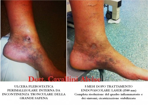 Come portano via vene varicose