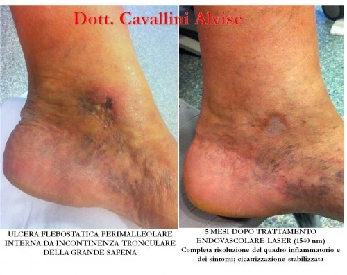 Il rimedio di gente più efficace di thrombophlebitis