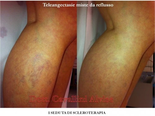Rassegne di pazienti di un flebologiya