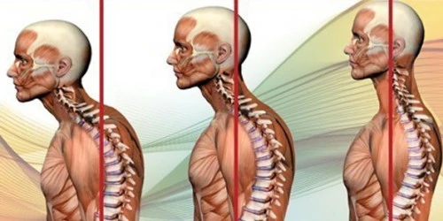 Trattamento dopo operazione su eliminazione di ernia intervertebrale