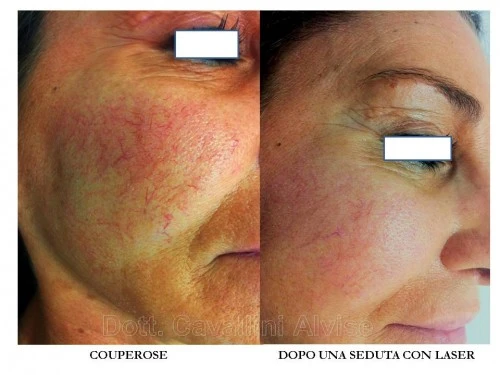 Cura chirurgica di una trombosi di vena