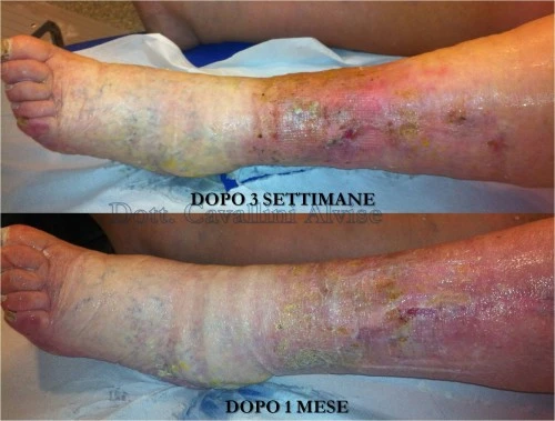 Sintomi di posizione di varicosity interna